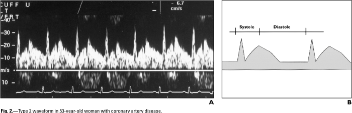 Early systolic deceleration vertebral artery