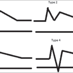 Artery vertebral subclavian ultrasound doppler steal flow waveform stenosis syndrome velocity forward medicina