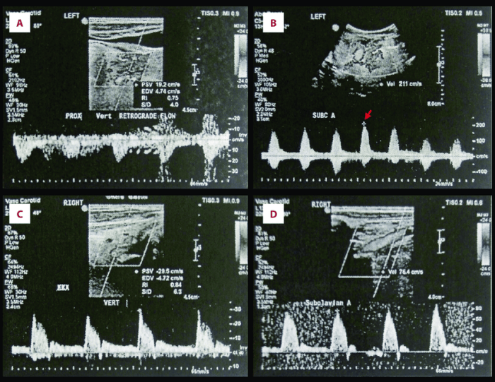 Early systolic deceleration vertebral artery