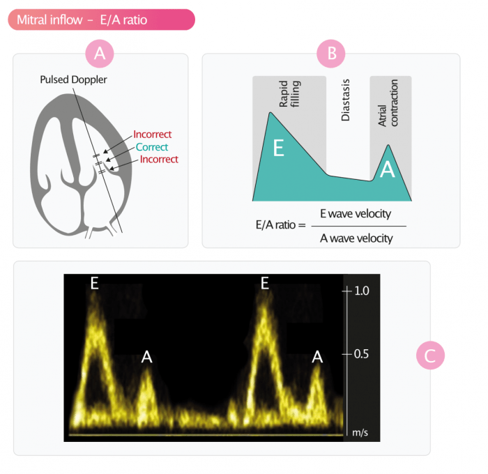 Doppler carotid ultrasound arteries steal waveform